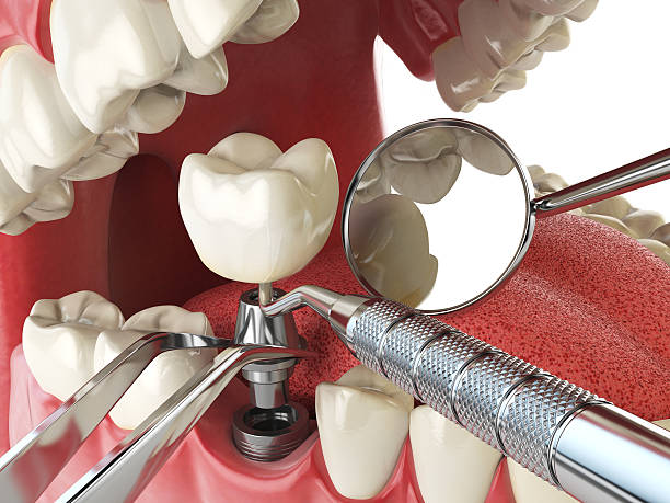 Best Emergency Root Canal Treatment in Tashua, CT